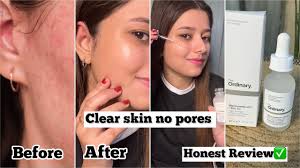 Buy 1Get 1Free Ordinary Niacinamide 10%+Zinc 1% 30ml (Pack 2)